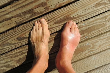 תביעת משרד הביטחון בגין תסמונת CRPS